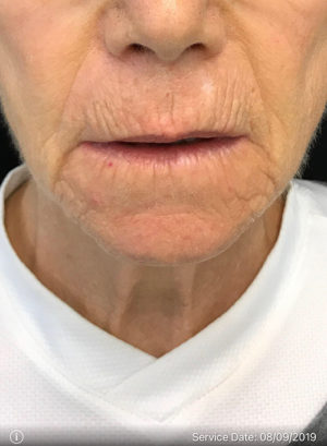 Around The Mouth Fillers