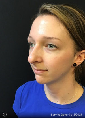 Restylane and Perlane