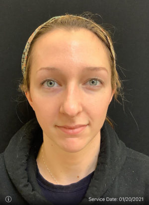 Restylane and Perlane