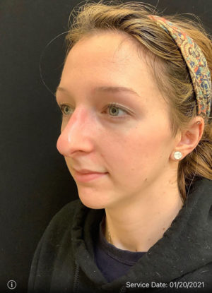 Restylane and Perlane