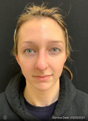 Restylane and Perlane