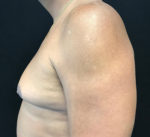 Gynecomastia