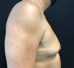 Gynecomastia