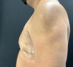 Gynecomastia