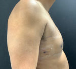 Gynecomastia