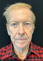 Under Eye Rejuvenation