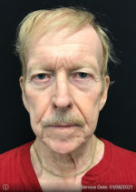 Under Eye Rejuvenation