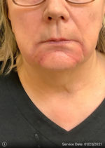 Around The Mouth Fillers