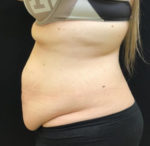 Tummy Tuck