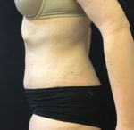 Tummy Tuck
