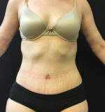 Tummy Tuck