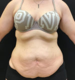 Tummy Tuck