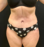 Tummy Tuck