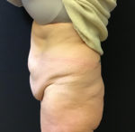 Tummy Tuck