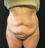 Tummy Tuck