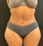 Tummy Tuck