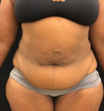 Tummy Tuck
