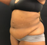 Tummy Tuck