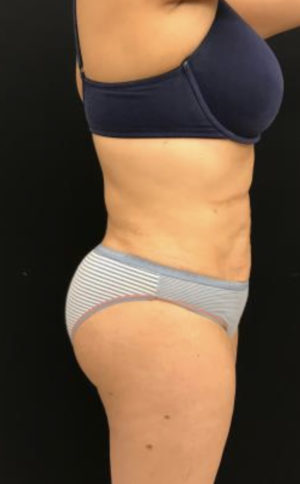 Brazilian Butt Lift
