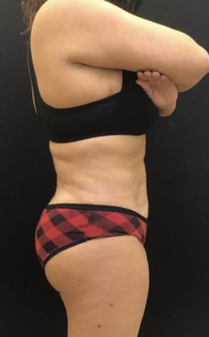 Brazilian Butt Lift