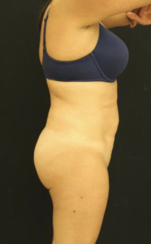 Brazilian Butt Lift