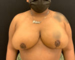 Breast Reduction