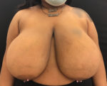 Breast Reduction