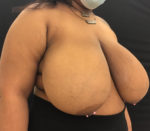 Breast Reduction