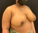 Breast Reduction