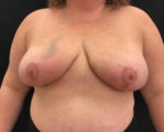 Breast Reduction