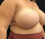 Breast Reduction