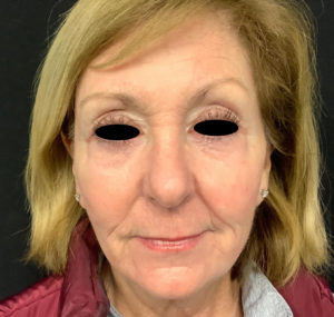 Upper Eyelid Blepharoplasty