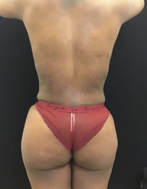 Brazilian Butt Lift