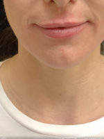 Lip Augmentation
