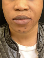 Lip Augmentation