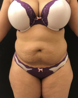 Liposuction