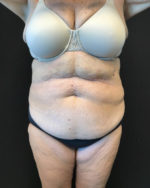 Liposuction