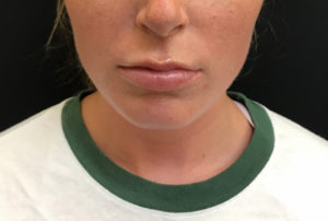 Lip Augmentation