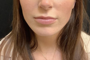 Lip Augmentation