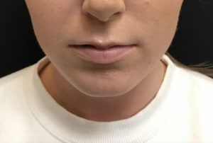 Lip Augmentation
