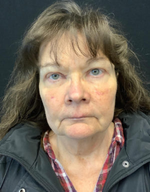 Upper Eyelid Blepharoplasty