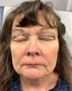Upper Eyelid Blepharoplasty
