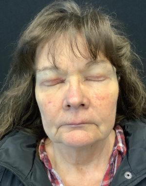 Upper Eyelid Blepharoplasty