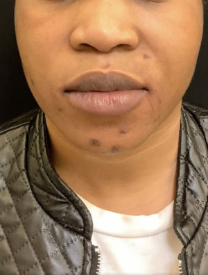 Around The Mouth Fillers