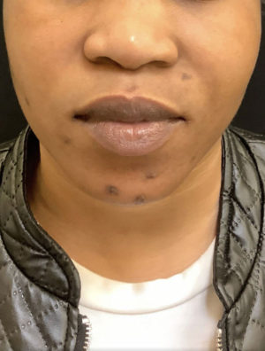 Around The Mouth Fillers