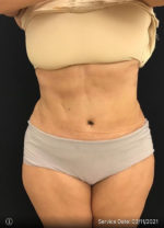 Liposuction