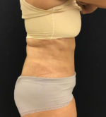 Liposuction