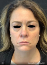 Under Eye Rejuvenation