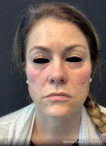 Under Eye Rejuvenation