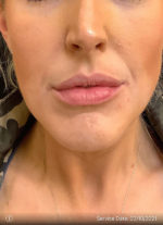 Lip Augmentation